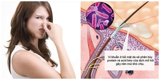 Dịch tiết trên da là "thức ăn" cho vi khuẩn gây bệnh hôi nách